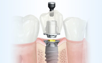 Dantų implantavimas švediškais dantų implantais „Nobel Biocare“
